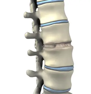 Anterior Lumbar Interbody