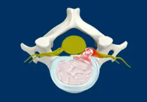 Cervical disc hernate