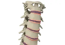 Cervical Spondylosis