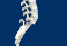 Isthmic Spondylolisthesis