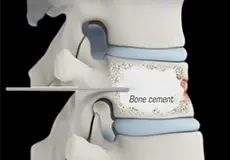 Vertebral Compression Fractures