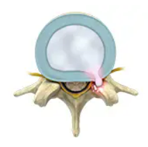 Lumbar Disc Herniation