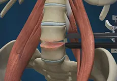 Lumbar Discectomy