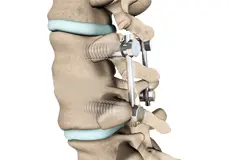Lumbar Spinal