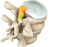 Lumbar Radiculopathy