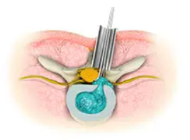 Minimally Invasive Spine